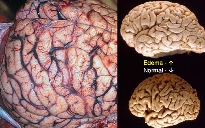 Normal Brain vs. Cerebral Edema