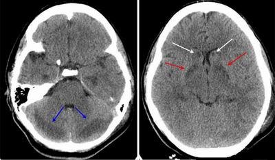 Presentation of Cerebral Edema on a CT-Scan