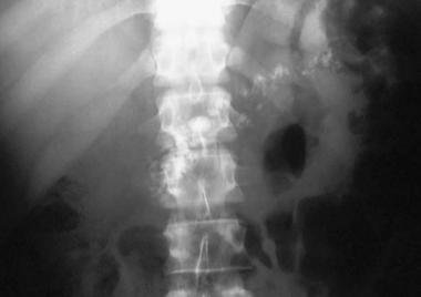 pancreatic calcification xray