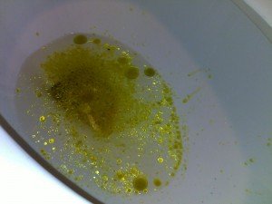 Greasy Stool - Causes, Pictures, Treatment, Diagnosis, Complications