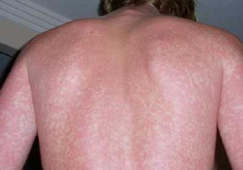 Lamictal rash