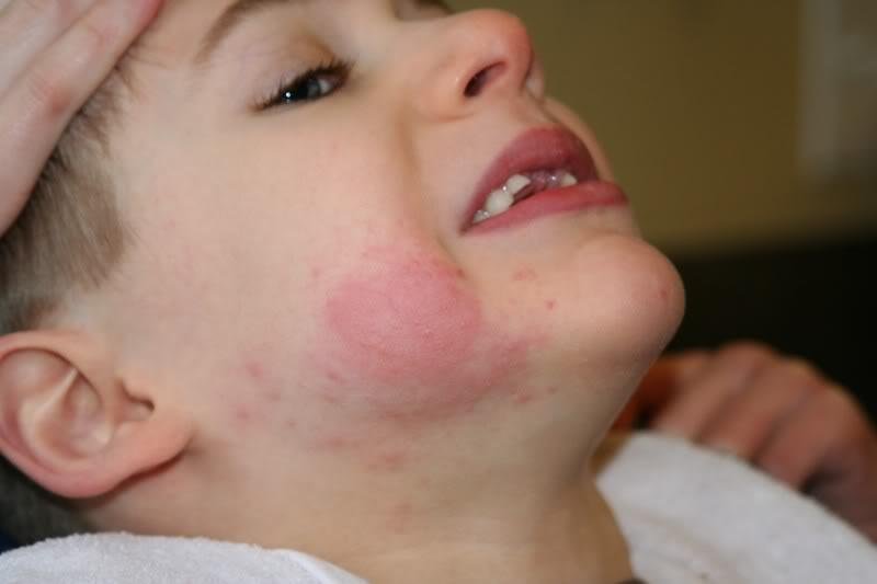 Lamictal rash