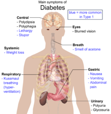 type 1 diabetes