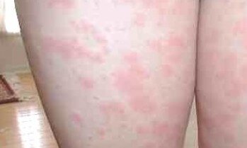 lamictal-rash-pictures 2