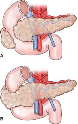 annular pancreas - incomplete pancreatic Annulus