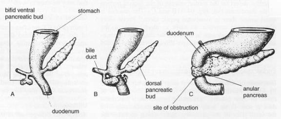 Annular Pancreas