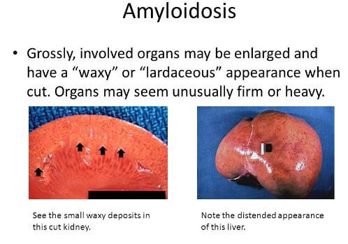 Amyloidosis of kidney liver