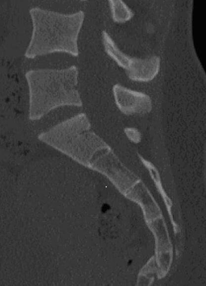 Broken Tailbone X Ray