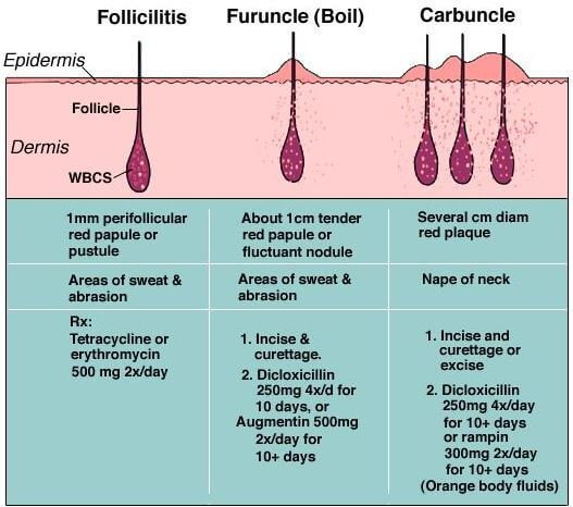 Furuncle Vs Carbuncle