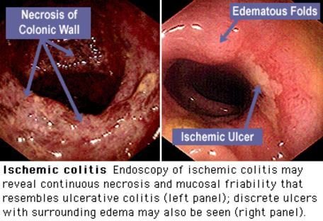 Hematochezia Diagnosis