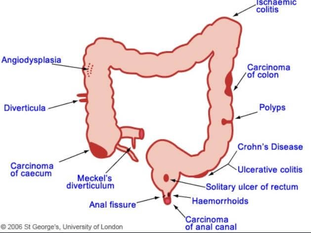 Hematochezia causes