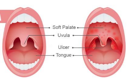 Herpangina Pictures of Mouth