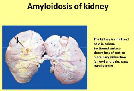 Kidney Amyloidosis