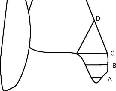 Medial Malleolus Fracture Types A B C D