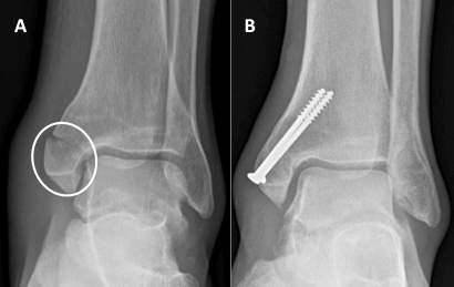 Medial Malleolus Fracture Surgery
