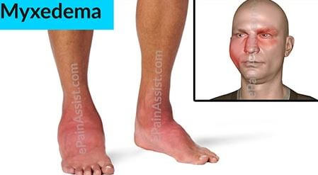 Myxedema of Ankles