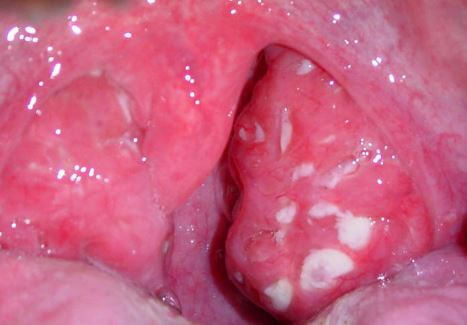 White Patches on Tonsils 2
