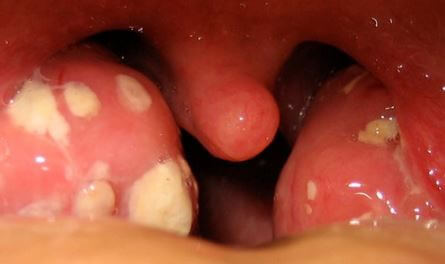 White Patches on Tonsils