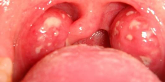 White Spots on Tonsils