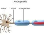 Neurapraxia