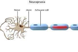 Neurapraxia