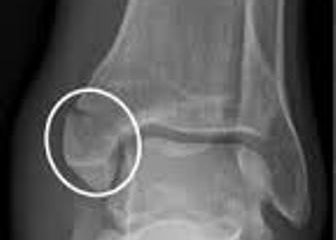 Medial malleolus fracture