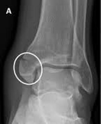 X-ray of Medial Malleolus Fracture