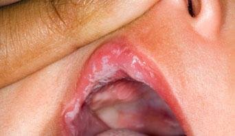 White Spots on Tonsils