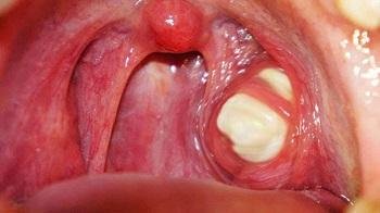 White Spots on Tonsils