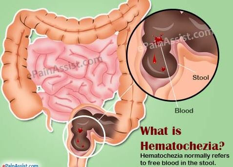 hematochezia symptoms