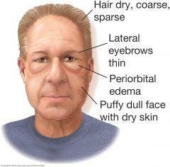 myxedema pictures facial edema