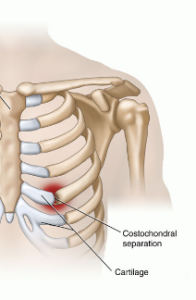 Dislocated Rib