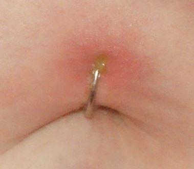 An infection after belly button piercing