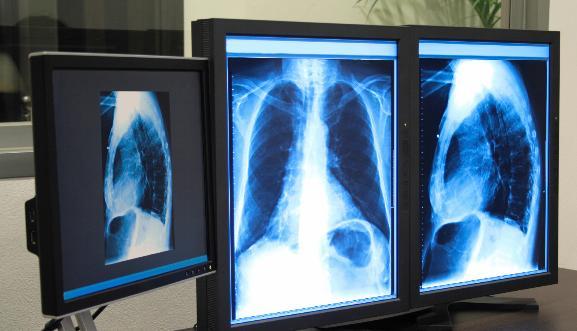 Radiology x ray dislocated rib