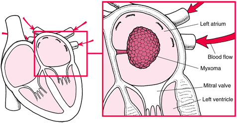 Atrial Myxoma of left heart