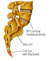 Fracture of tailbone