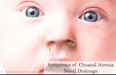 unilateral Choanal atresia