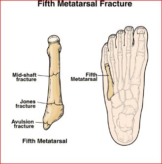 fifth metatarsal fracture