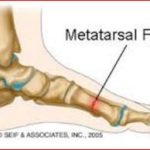 Metatarsal Fracture