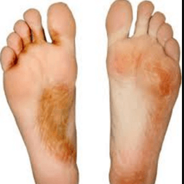 Vesicular Athlete’s Foot picture 3