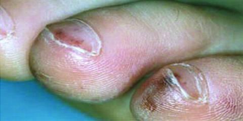 Splinter Hemorrhages on nail picture 2