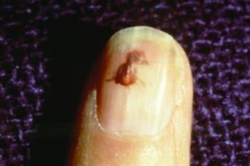 Splinter Hemorrhages on nail picture 3