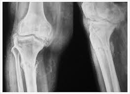 Osteophytosis of knee