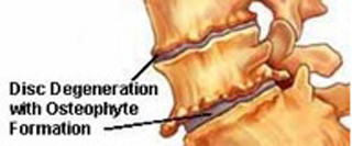 Osteophytosis on spine