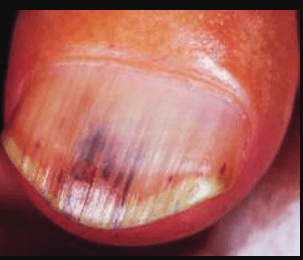 Splinter Hemorrhages on nail picture 1