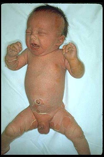 Staphylococcal Scalded Skin Syndrome