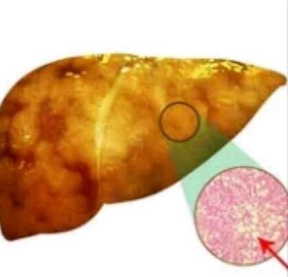 Tyrosinemia (liver)