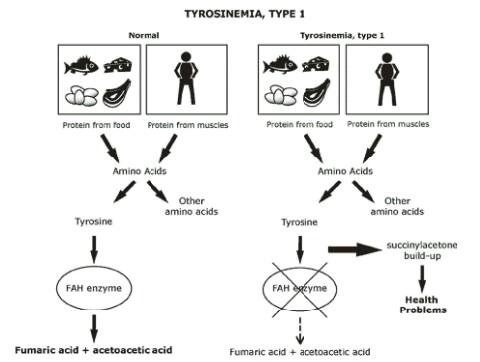 Tyrosinemia Type I