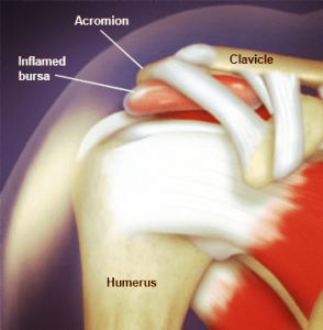 Shoulder Pain Picture 1