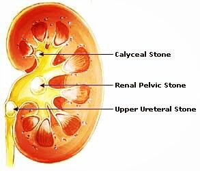 Kidney Pain Picture 2